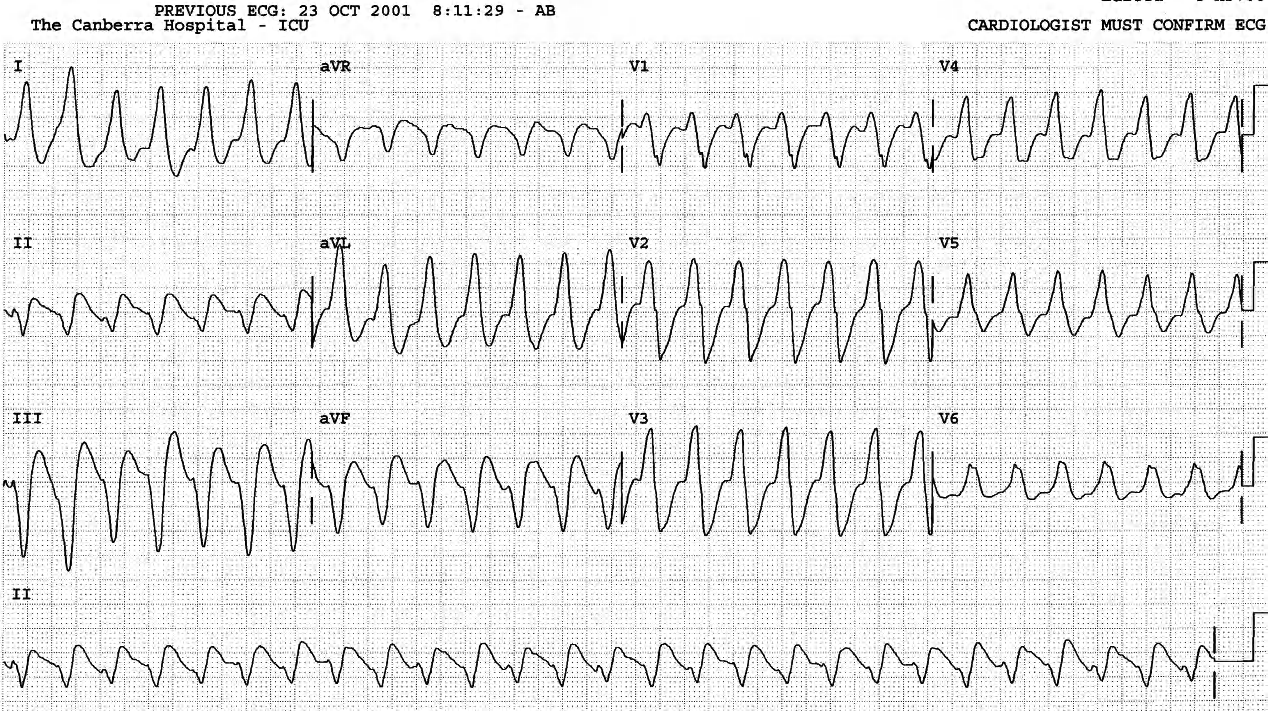 Broad-complex tachycardia in ICU, with blood pressure 80/46 mmHg, 9 days after emergency AAA repair. There is no response to drugs. 