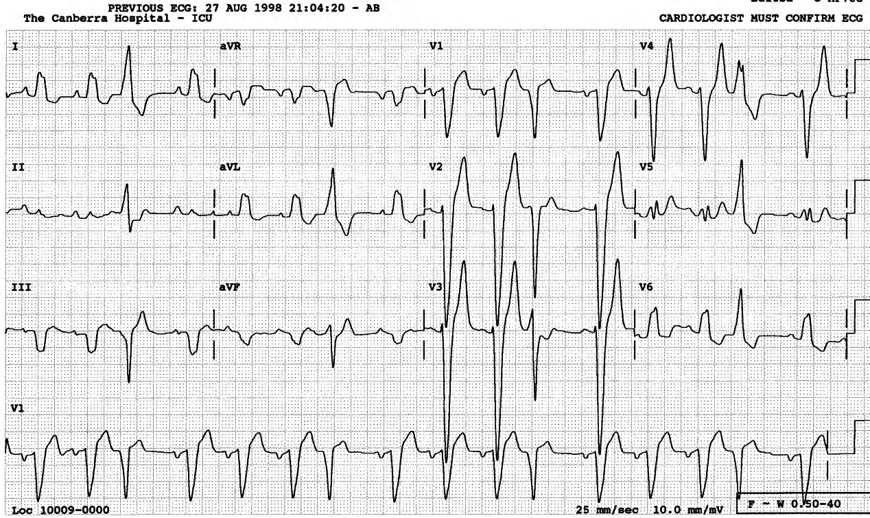 The cause of prominent midprecordial T waves is unknown. 