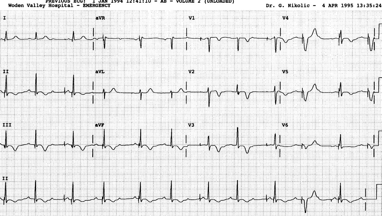 39 year old woman with permanent
pacemaker following radiofrequency ablation for SVT.