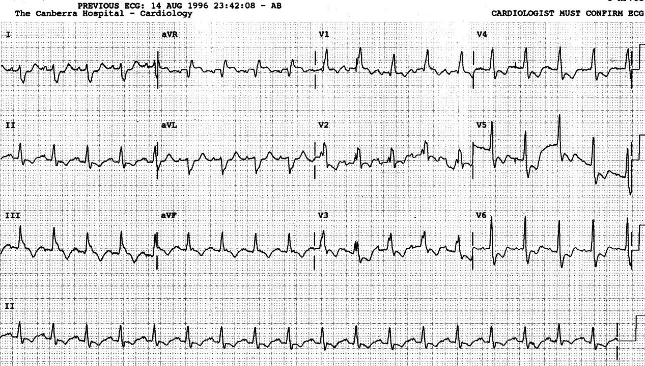 79 year old man with permanent pacemaker inserted for LBBB and 2o AV block three years previously.