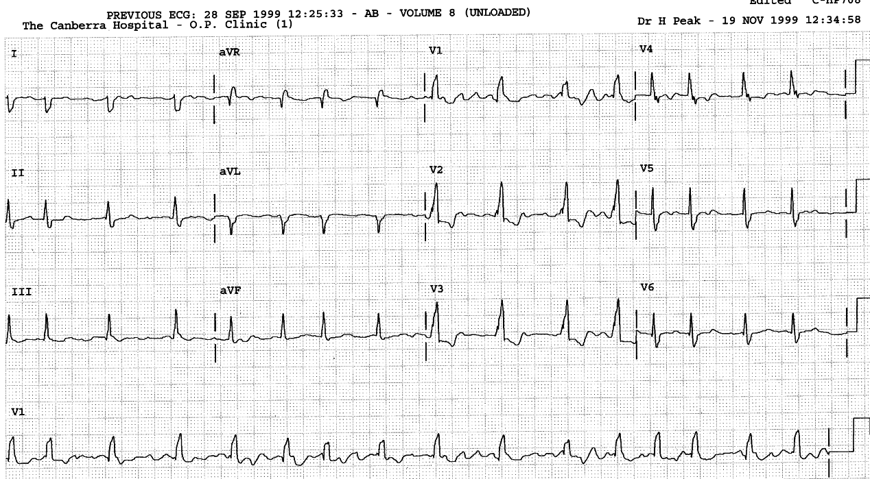 67 year old lady with chronic AF and a question of right ventricular hypertrophy