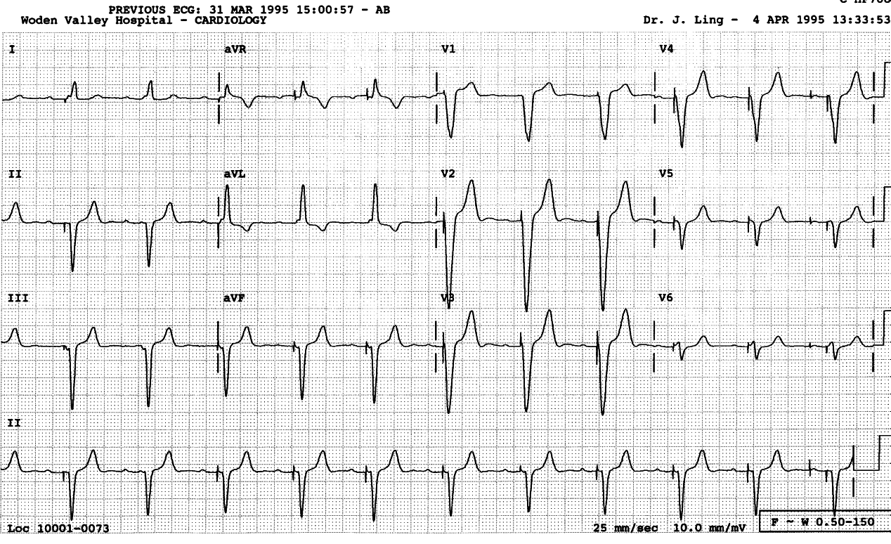 Lead 2 can be very misleading in terms of ventricular
conduction.