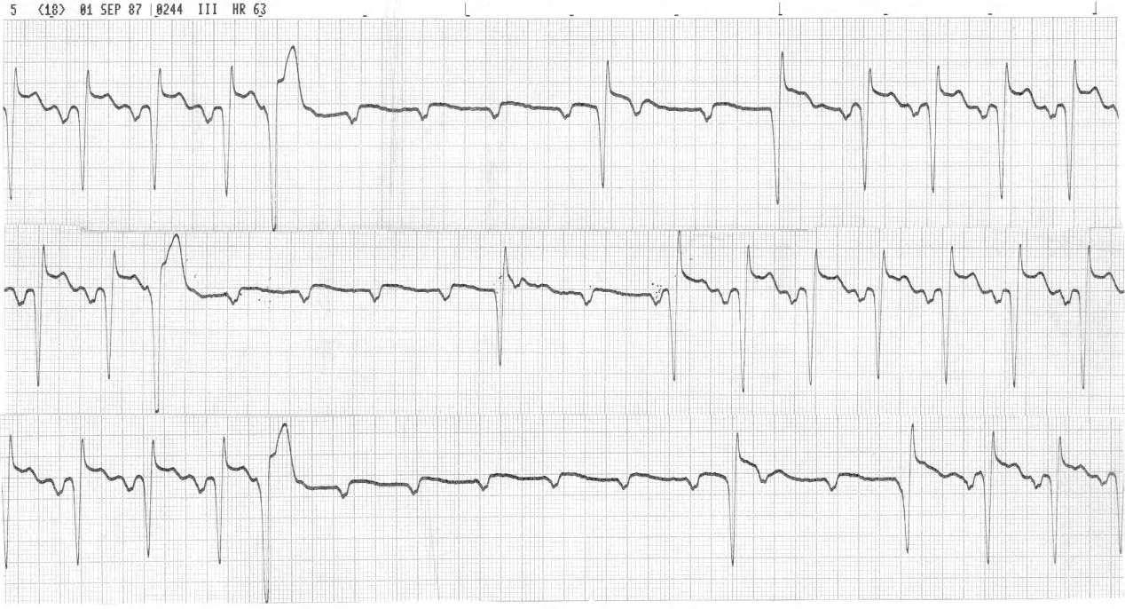 Unusual extrasystoles in a 47 year old man one day after acute anteroseptal infarction. New RBBB/LAHB and LBBB occurred, at different times, on his 12-lead ECGs. He had persistent chest pain while on a nitroglycerin infusion but seemed unaware of the arrhythmia. 