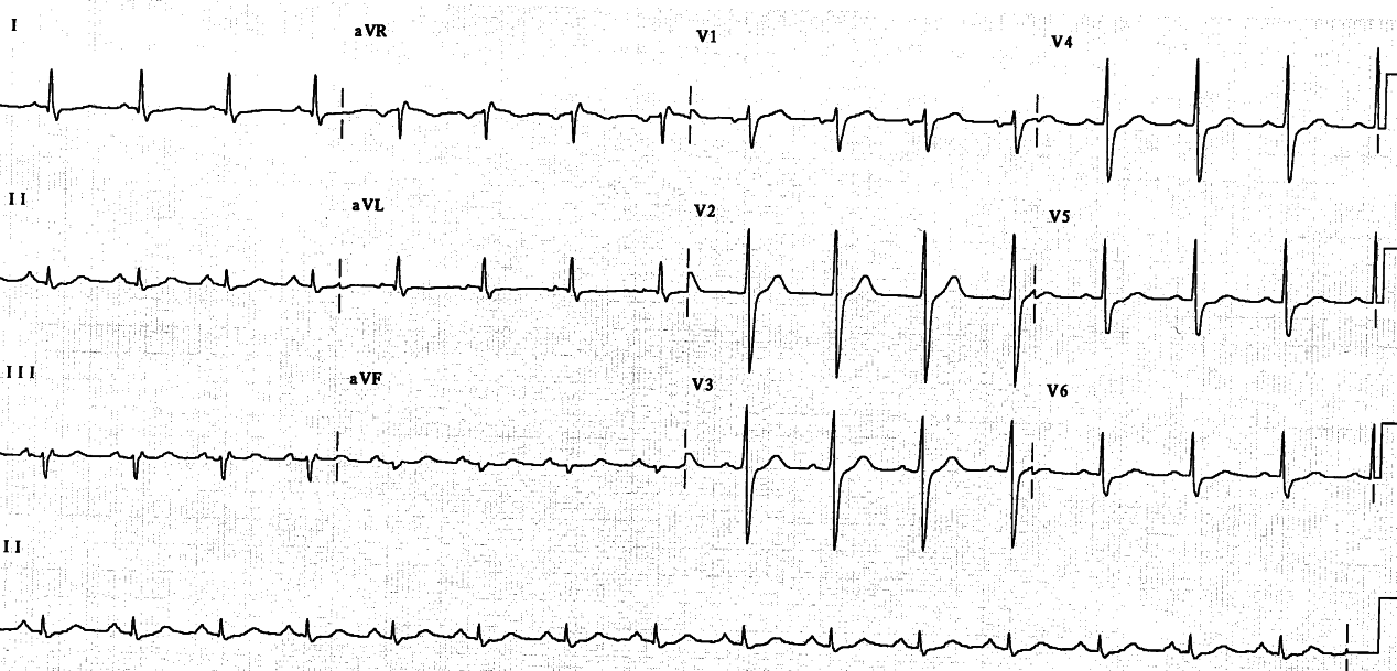 This preoperative ECG would have been a dangerous document in Coronerâs Court had the patient died from his infarction.