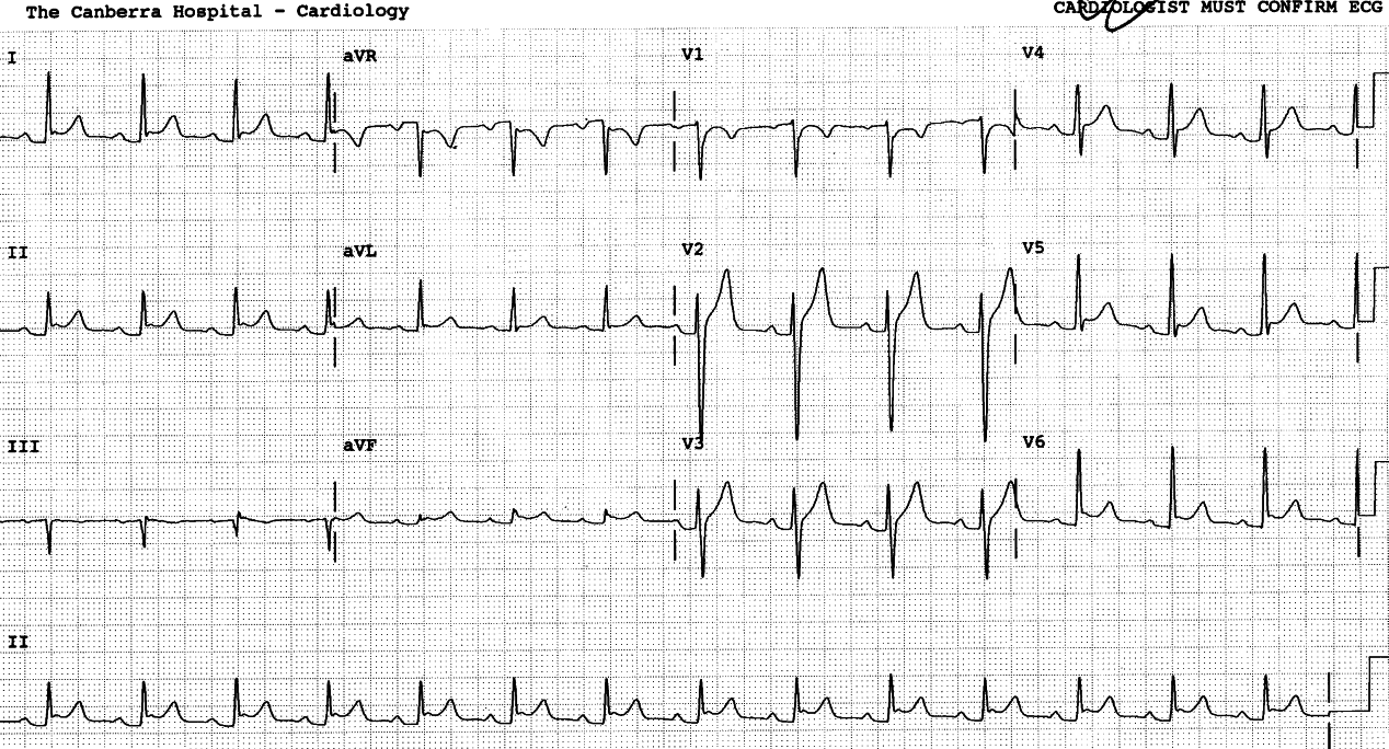 PR segments are still down the next day, exaggerating the independent ST segment elevation.