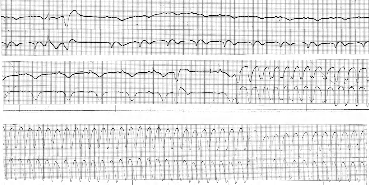 Two-channel Holter monitor recording on a 57 year old man with anterior infarction three weeks previously. At the onset of tachycardia, he experienced palpitations, but was otherwise asymptomatic. He became pulseless in EMD when carotid sinus massage was applied (lower strip) and could not be resuscitated. 