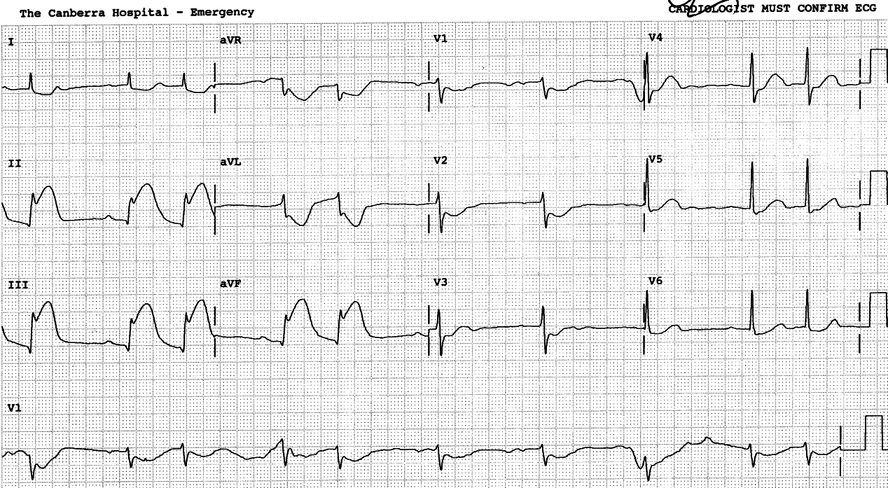 The differential diagnosis is between 2o AVB and SVEBs.