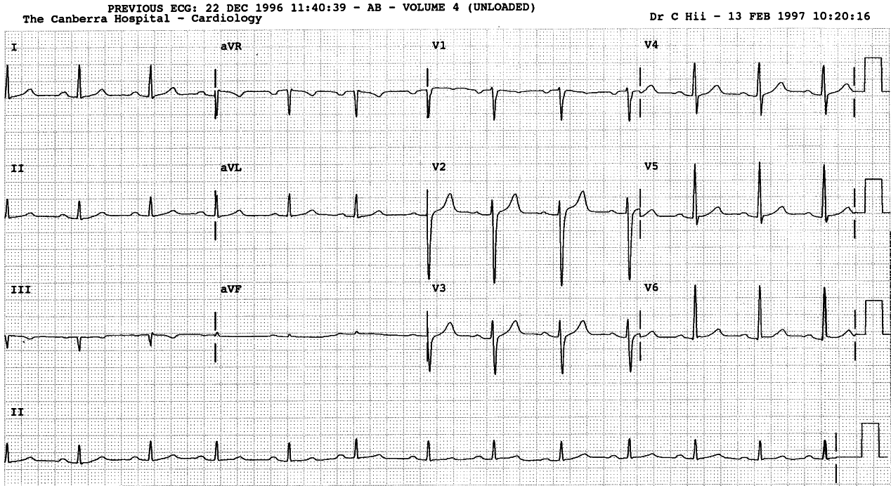 Normalised ECG in 3 months. This patient did everything by the book