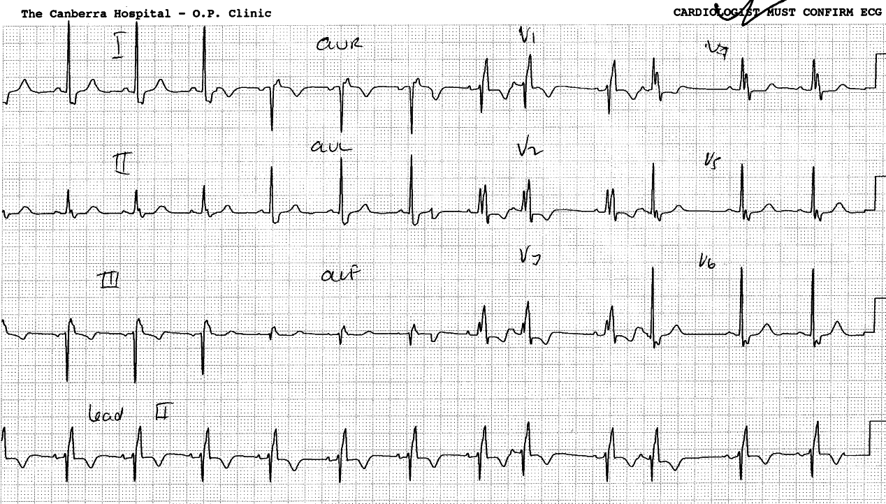 Transition from aVL to V2 simulates a large Pâ wave, which would be, electrocardiographically, absurd.