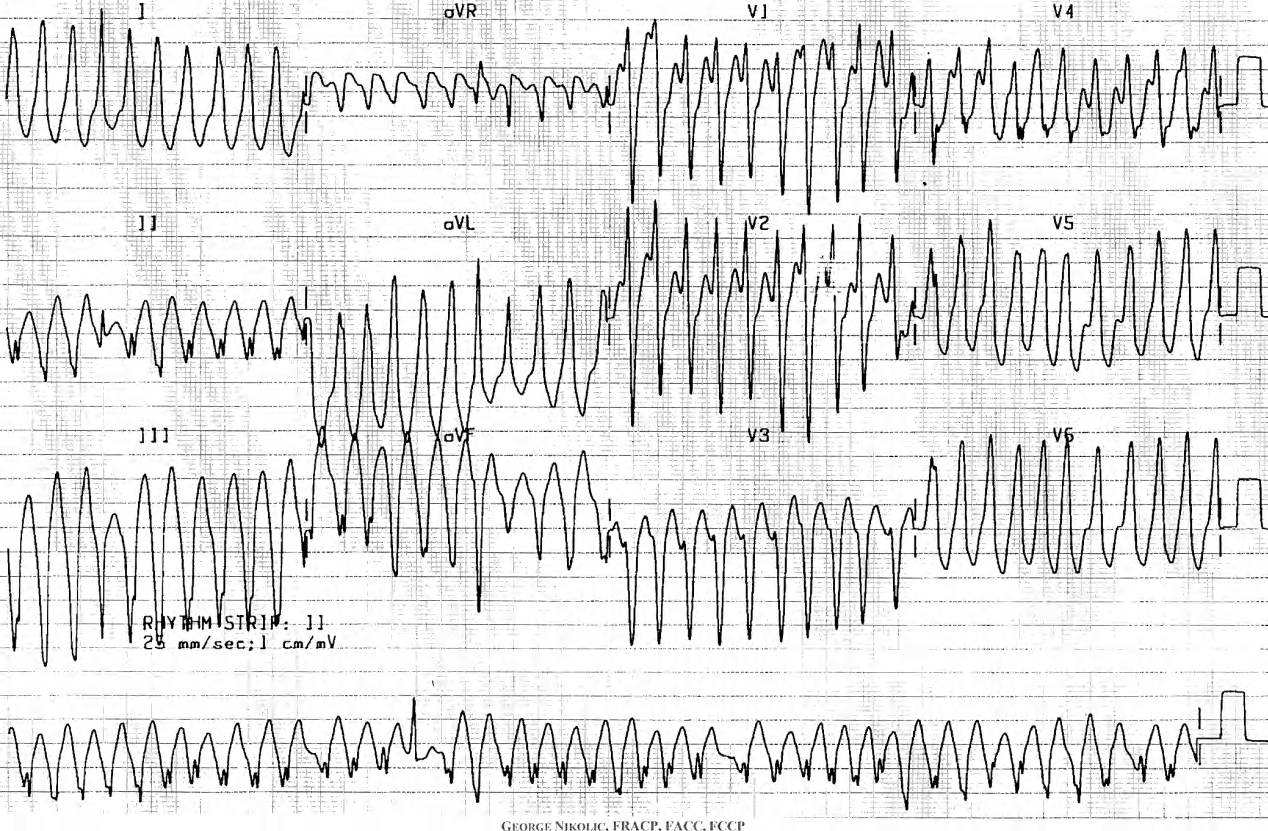 20 year old with recurrent palpitations associated with weakness and dizziness. 