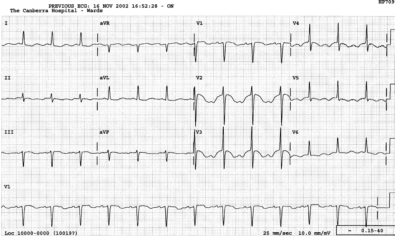 81 year old man in the geriatric ward, senile but asymptomatic