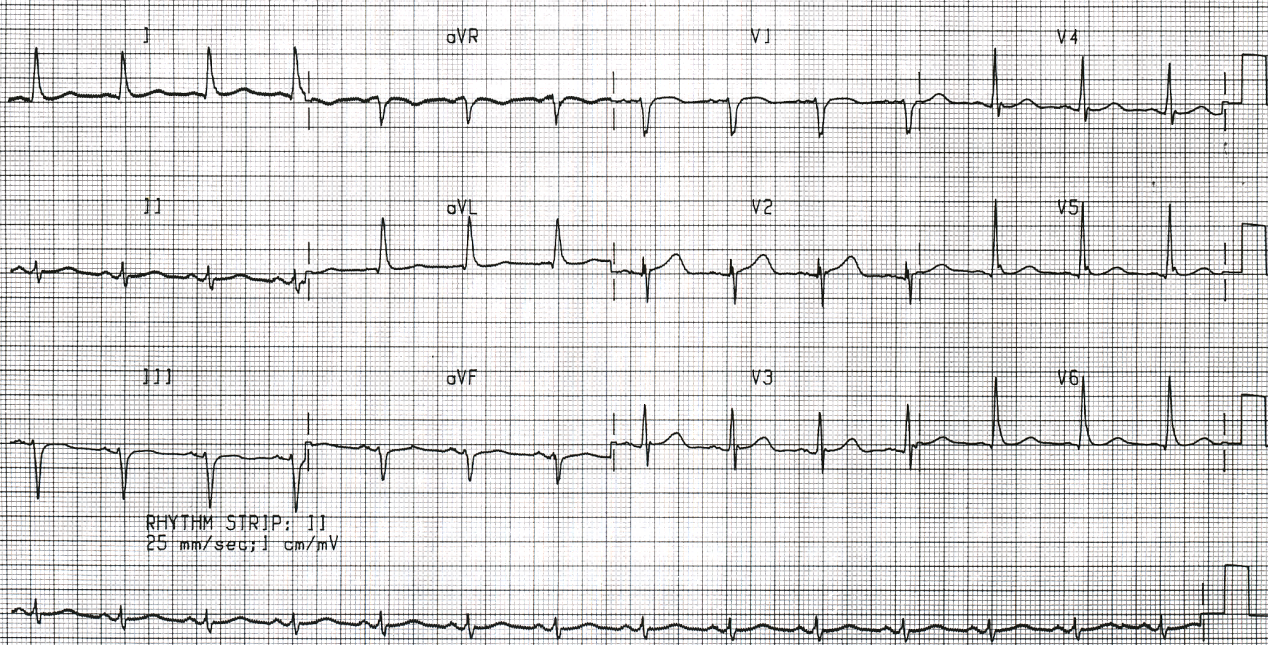 Diminishing hypothermic humps.