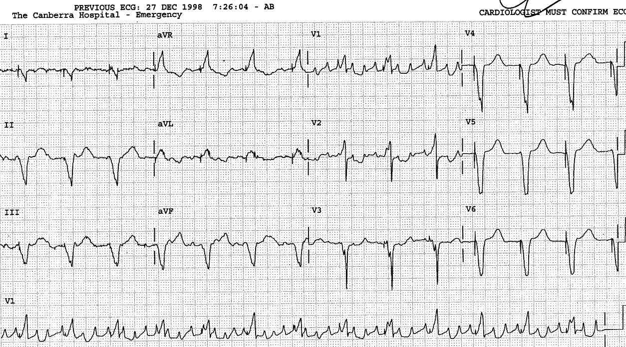 49 year old man with congestive cardiomyopathy and history of
His bundle ablation for intractable atrial
tachyarrhythmias.