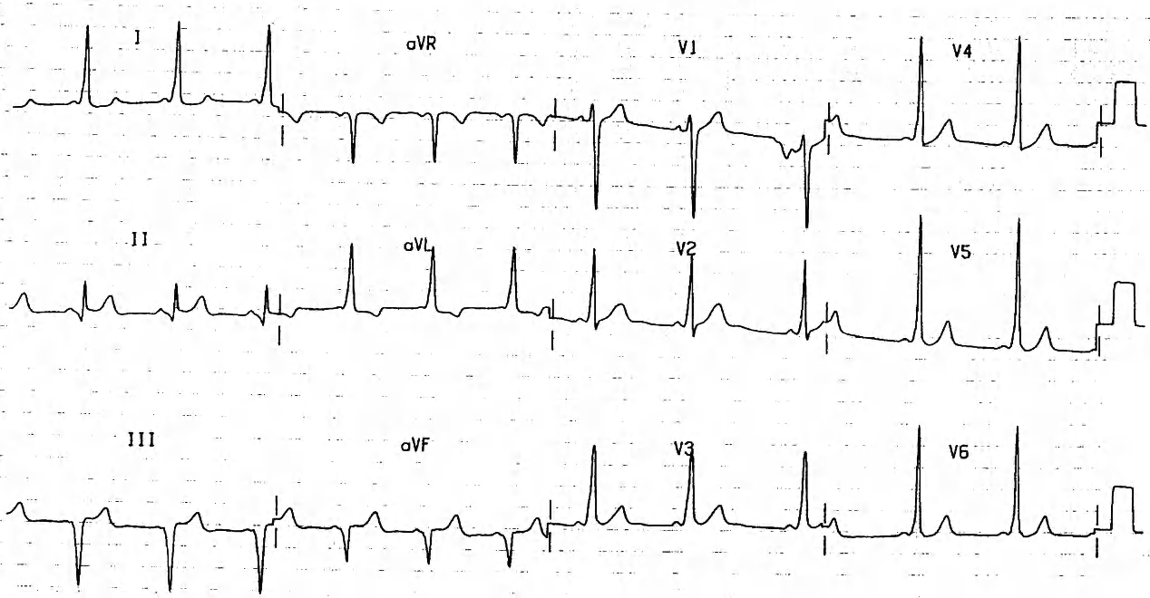 Typical WPW âBâ in sinus rhythm. 