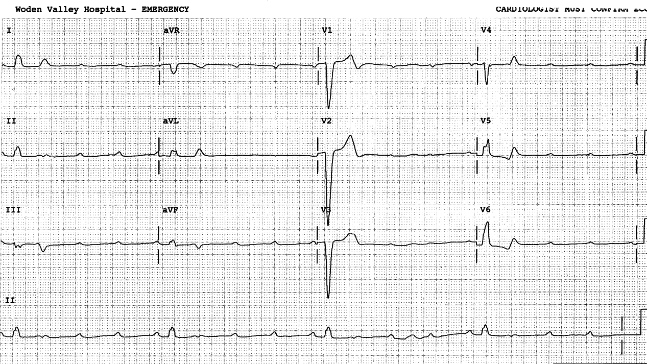 61 year old farmer and (active) amateur pilot, admitted for asymptomatic bradycardia. 