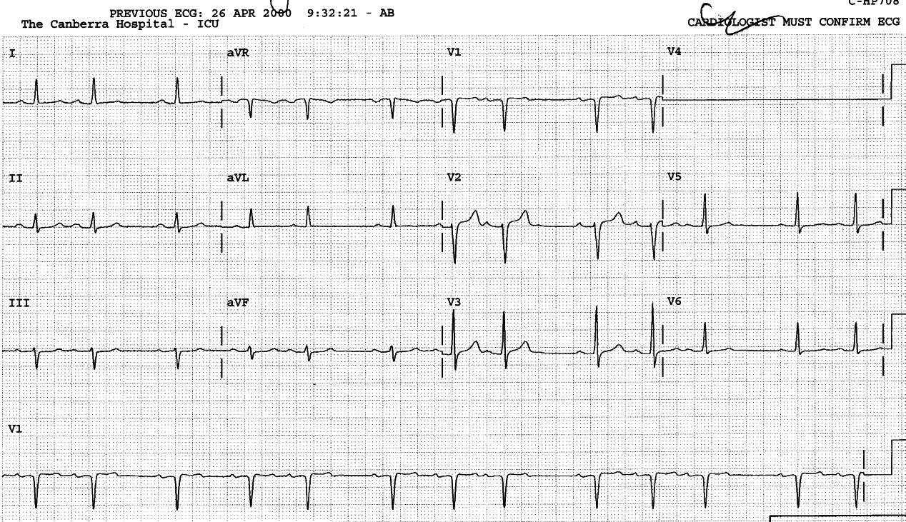 77 year old lady with a recent CVA