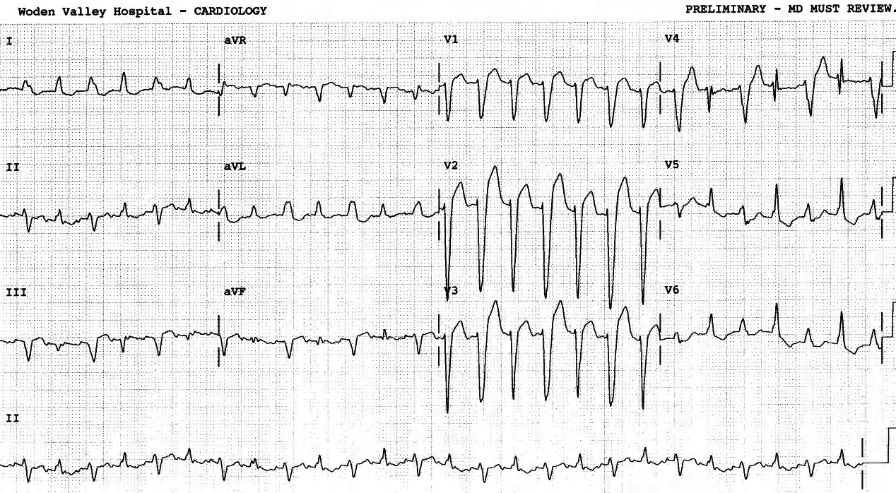 71 year old man with known LBBB, during a paroxysm of recurrent tachycardia, cardioverted with 15 Joule countershock. 