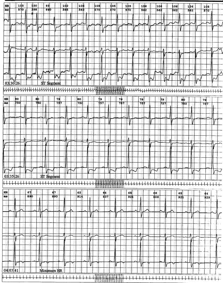 Holter strips in a 90 year old lady with recurrent falls. No arrhythmia was documented, but...