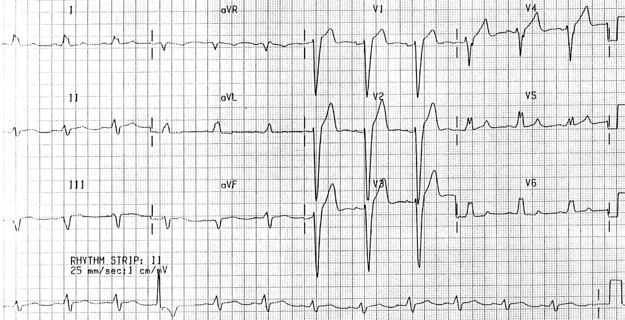 Sinus rhythm, with complete LBBB alone. Thereâs a fusion VEB in the (unsynchronised) rhythm strip. 