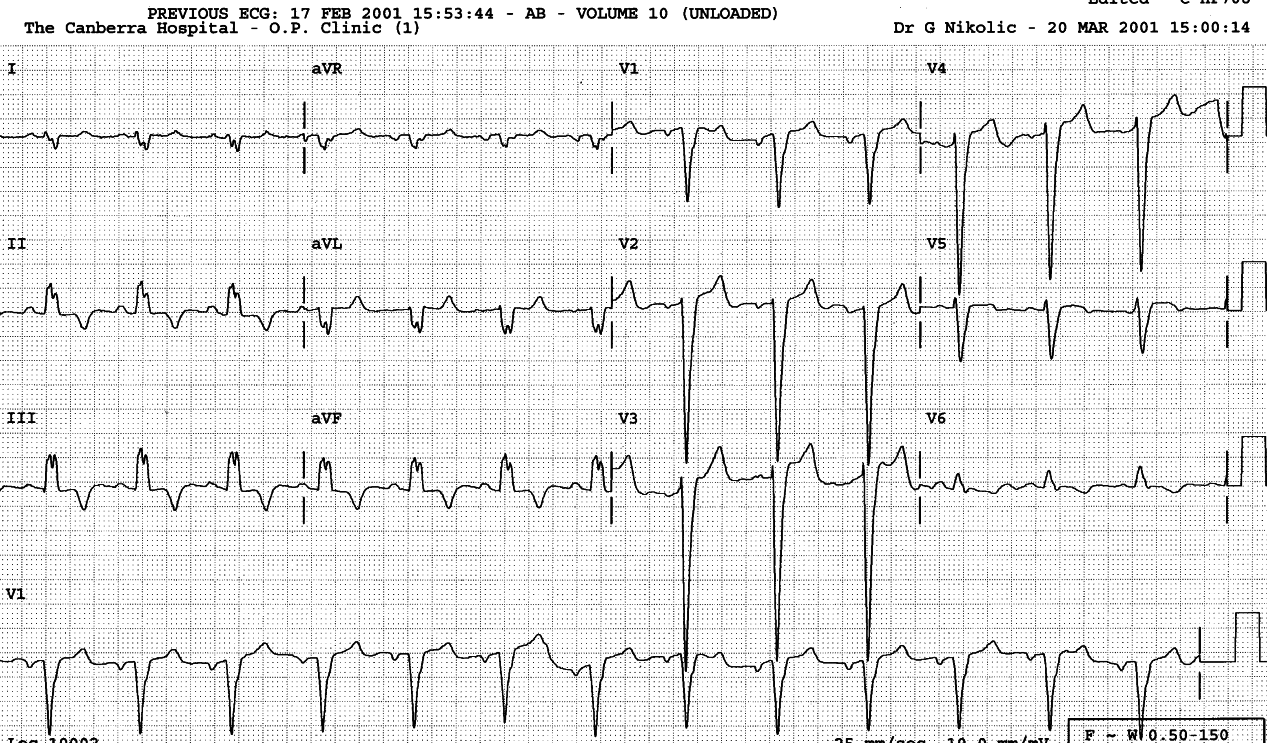 Later ECG, in ischÃ¦mic congestive cardiomyopathy.