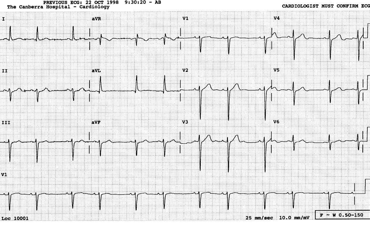 Another brain-stem infarct, in sinus bigeminy.