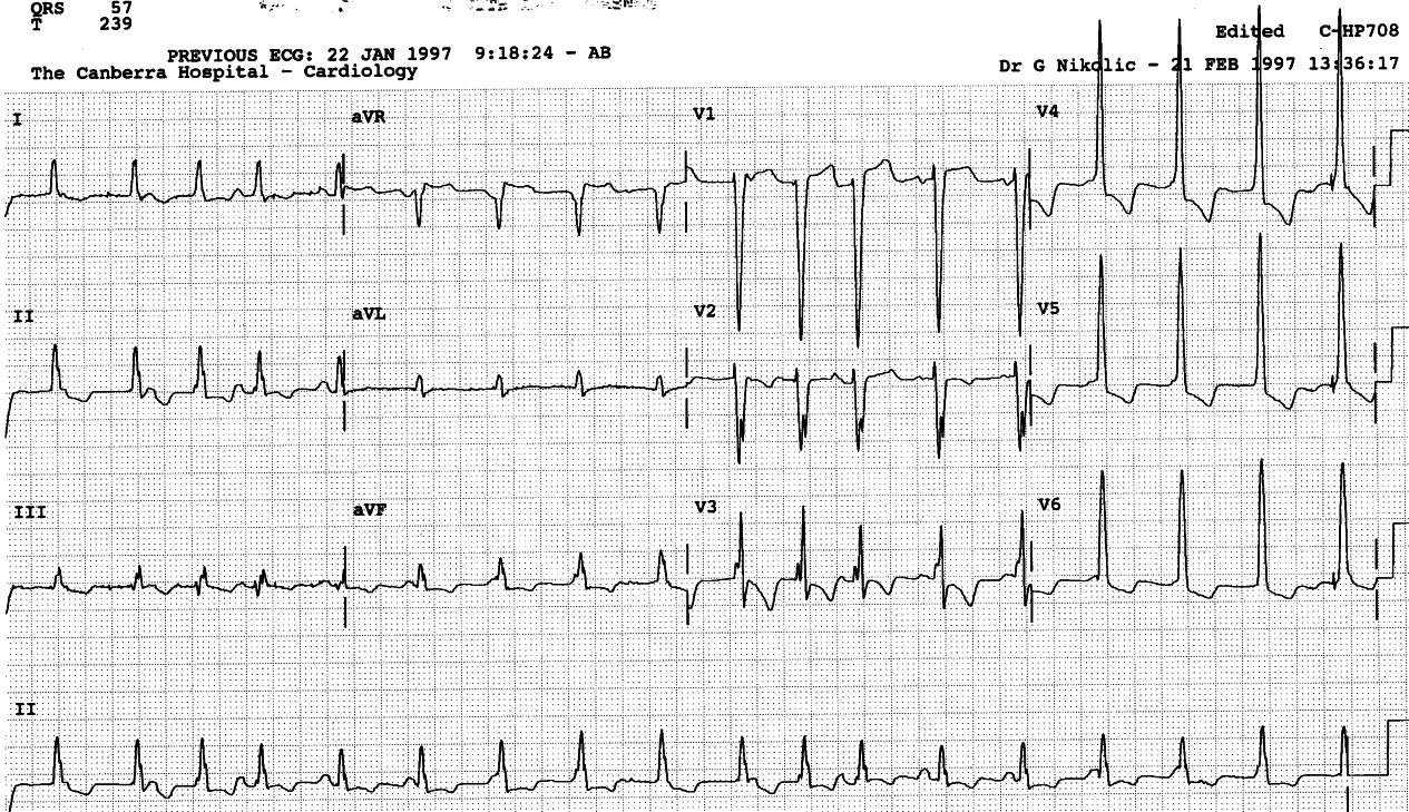 75 year old hypertensive woman recovering from a     CVA, on digoxin and enalapril for left ventricular failure. Her sinus     rhythm has few opportunities in this trace; when it gets them, it     hurries to be conducted to the extent that it becomes faster than       itself! 