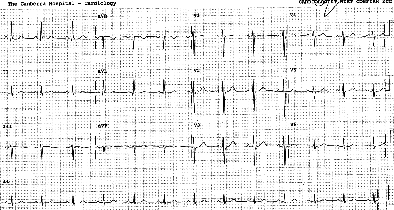 Fit, fat, fair and flatulent lady of 47, awaiting elective cholecystectomy