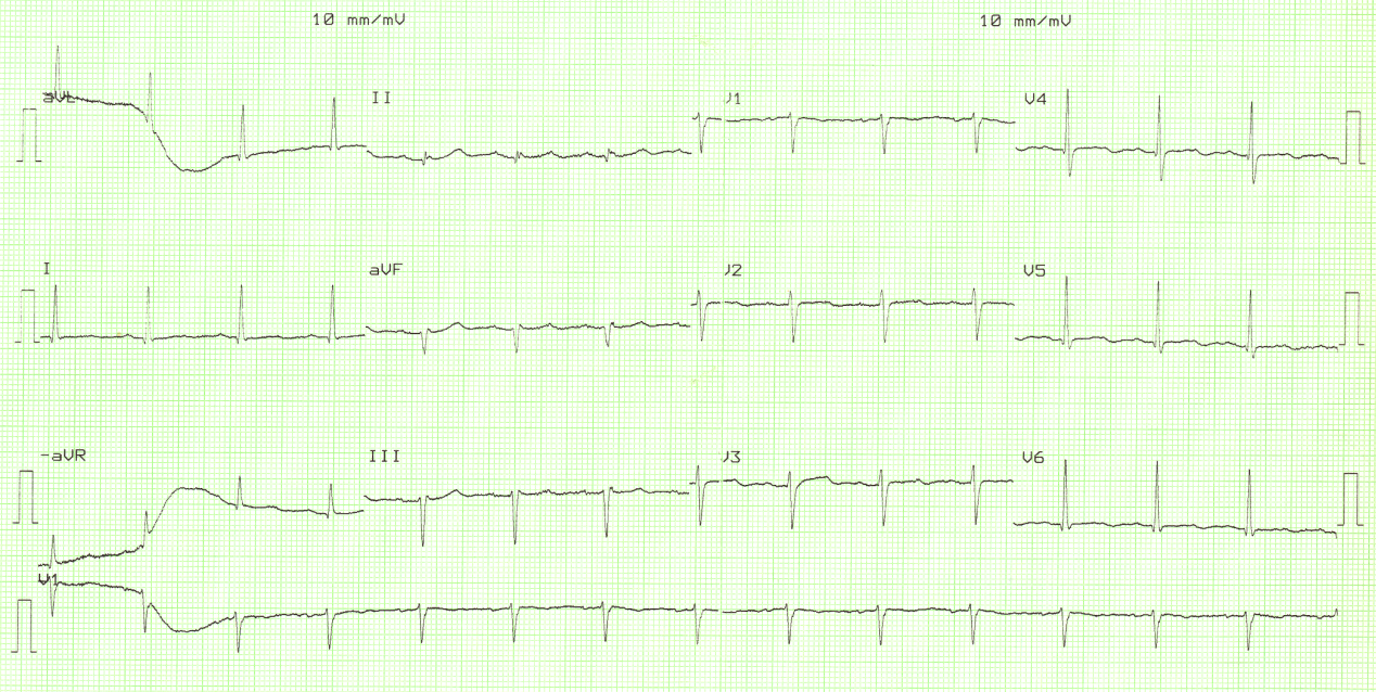 87 year old man admitted for elective herniorrhaphy