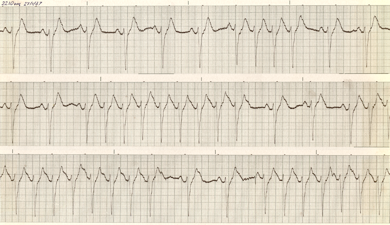 Evidence     of anterior and inferior infarction in junctional escape rhythm.