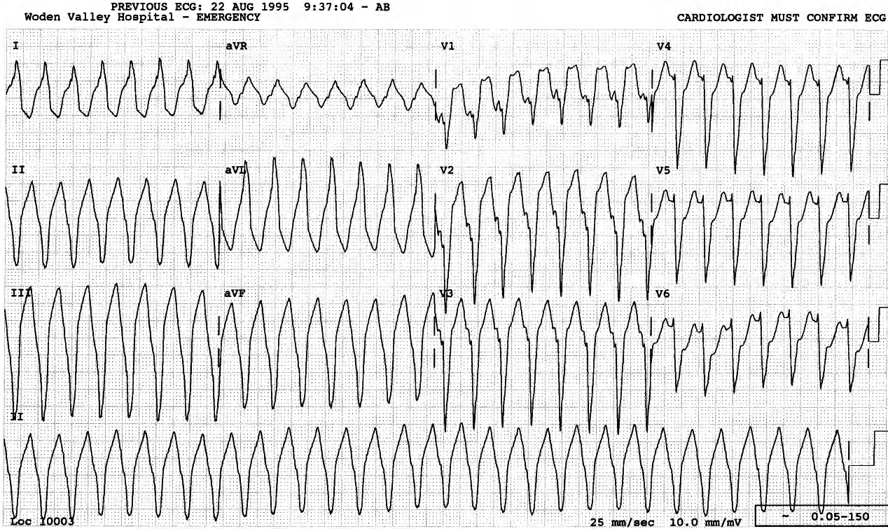 36 year old lady developing palpitations and dyspnÅa many years after surgical repair of foramen secundum ASD. 