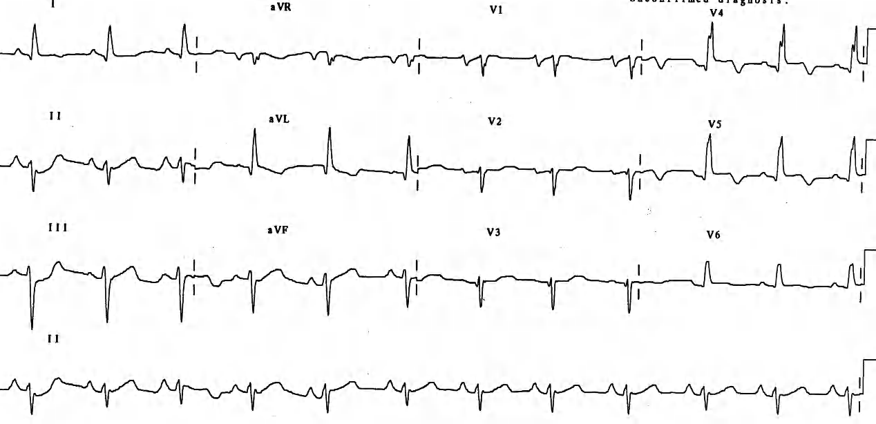 Obvious anterior infarction. 