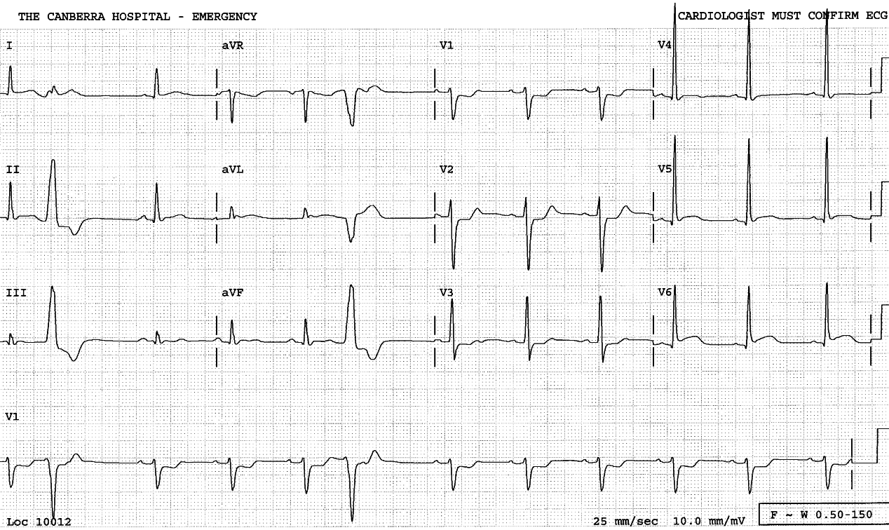 ECG day laster. The repolarisation changes appear resolving following the PTCA, but the T waves will eventually invert.