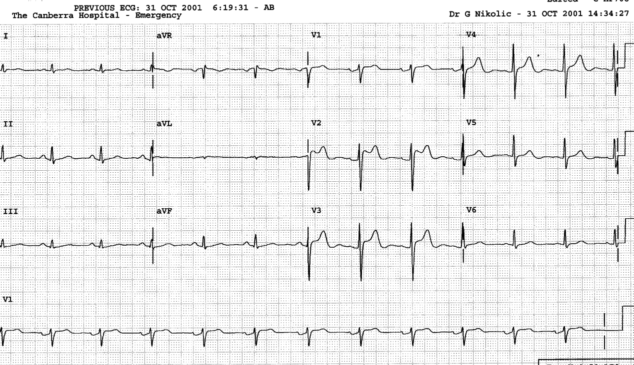 54 year old man discharged from Casualty following a syncopal episode