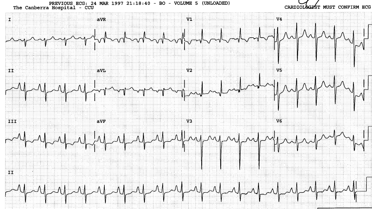 Retarded 28 year old hydrocephalic with one weekâs history of weakness and Ådema