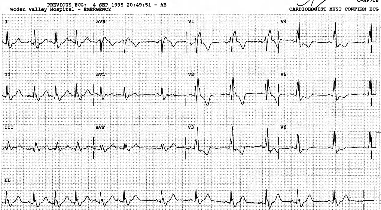 There is marked sinus arrhythmia, normal in a (relatively) young subject. ECG technicians used to ask patients to take a deep breath if there were any inferior Q or q waves. There isless human input nowadays.  