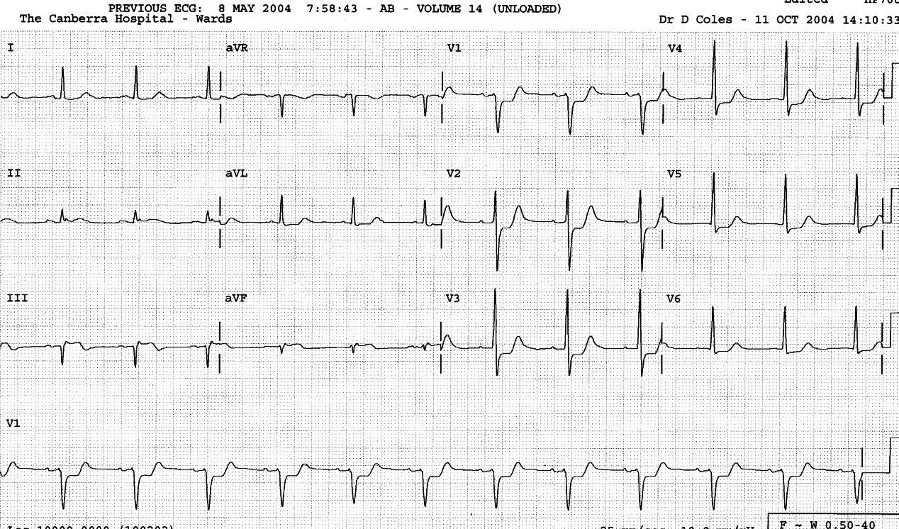 60 year old man with chest pain.