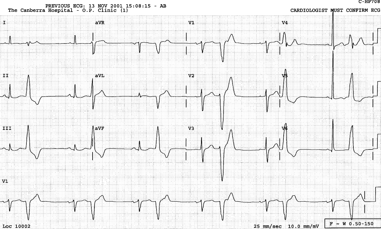 Holter monitor of an 87 year old man, too old for an exercise test.