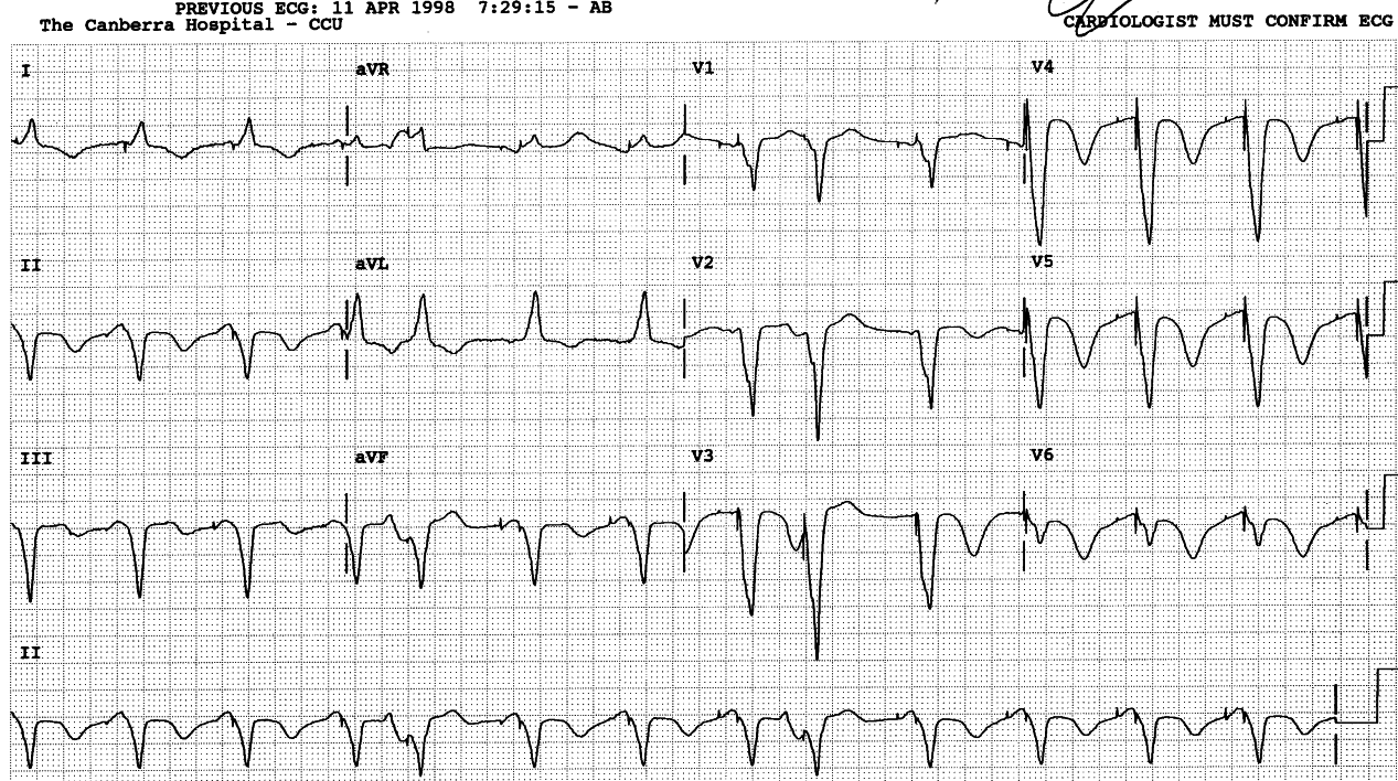 68 year old woman with a permanent pacemaker. She may have more
than conduction problems.