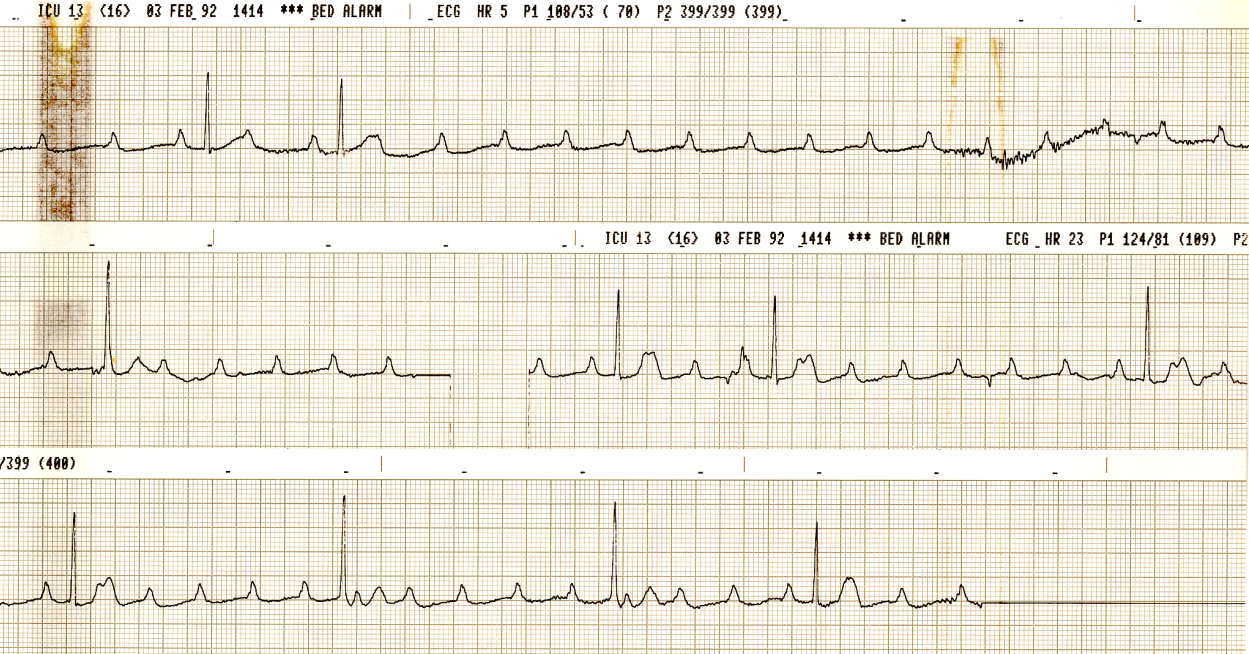 50 year old woman with known polyarteritis nodosa and     hypertension. 