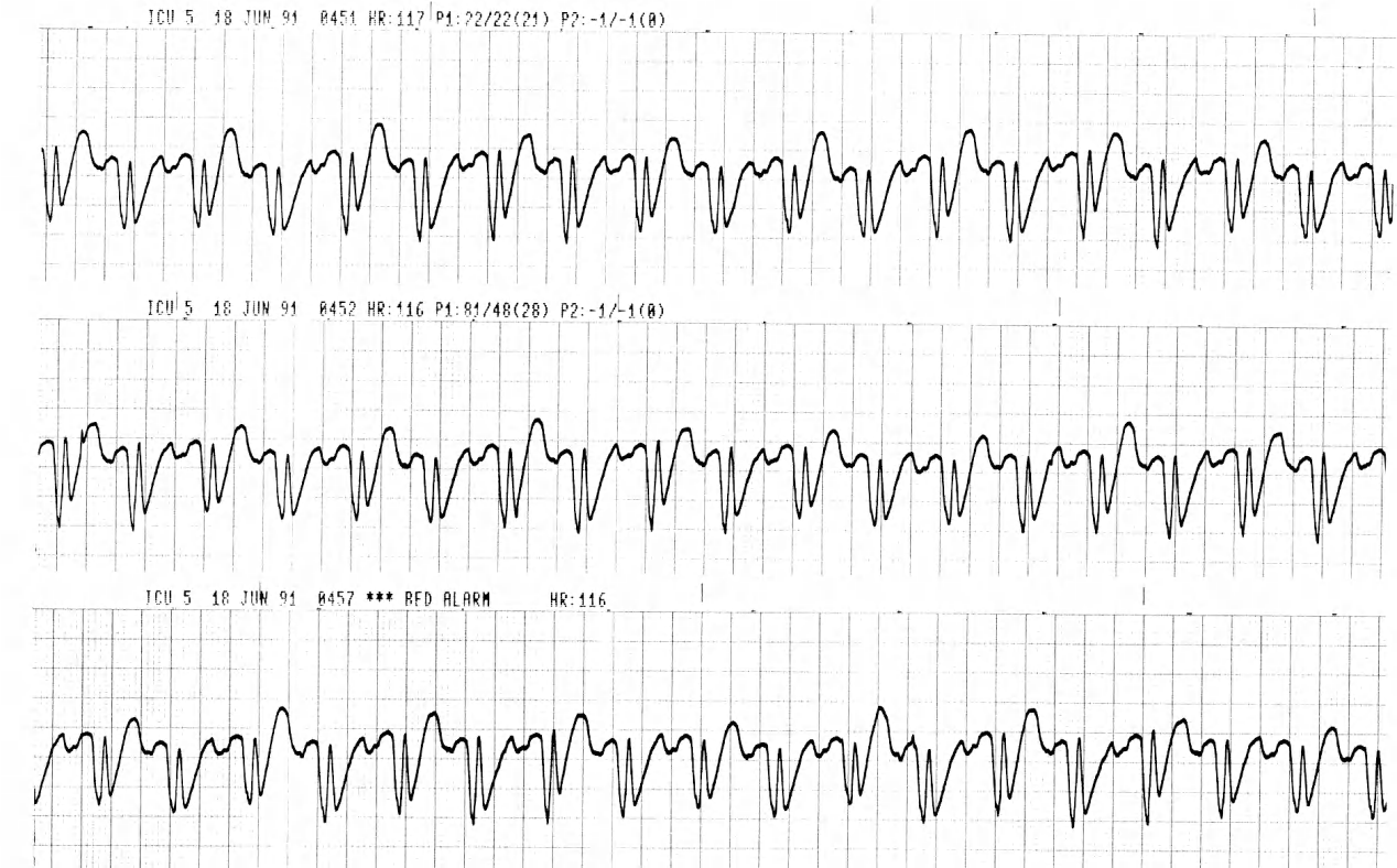 Pre-intubation strips on a 30 year old tricyclic overdose male with coma, hypotension and mixed acidosis. 