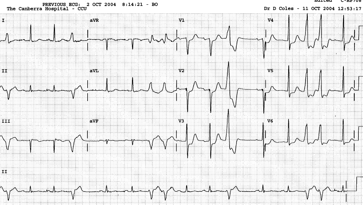 The VEB couplets occupy the same pause as the single VEBs, but the former extract their toll on the following PR interval by concealed conduction. The first VEB is therefore part of a couplet. Another corollary is that the sinus rate is slightly faster than that obtained from the QRS complexes.