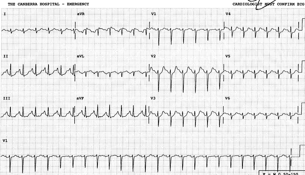 Anxious 23 year old lady complaining of sharp but inconsistent chest pains