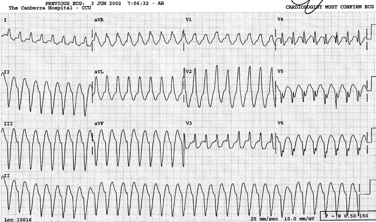 Same VT a year later. The rabbit ears in V1 are useless and the complex should be regarded as a monophasic R wave. The precordial sequence is diagnostic of VT. 