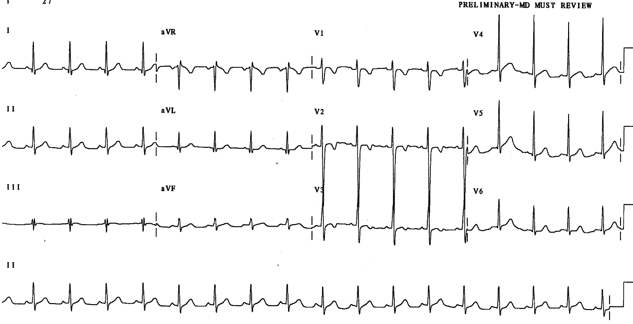 9 year old boy with febrile illness suggestive of Kawasakiâs disease.