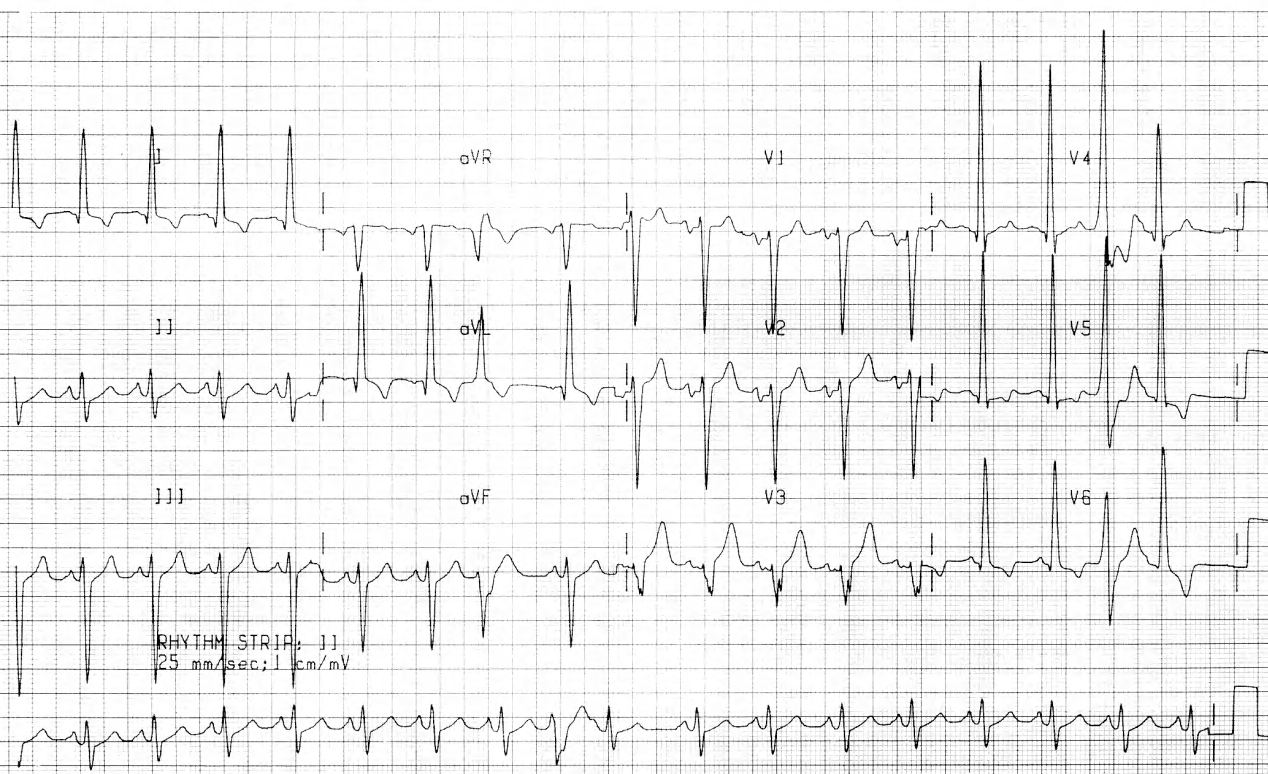 In couplets, only the first SVEB is aberrant â unexpectedly, on the RBBB side. 