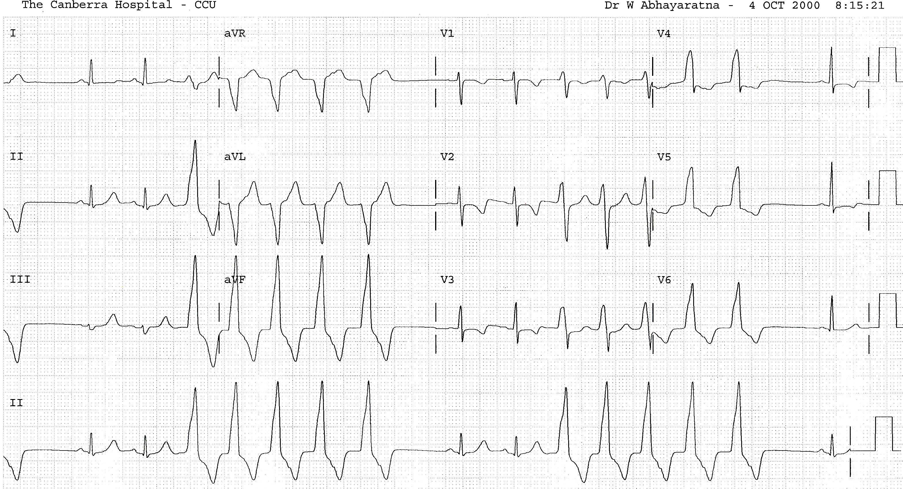 ECG before beta-blockade. Runs of AIVR stun the SA node by means of retrograde conduction. 