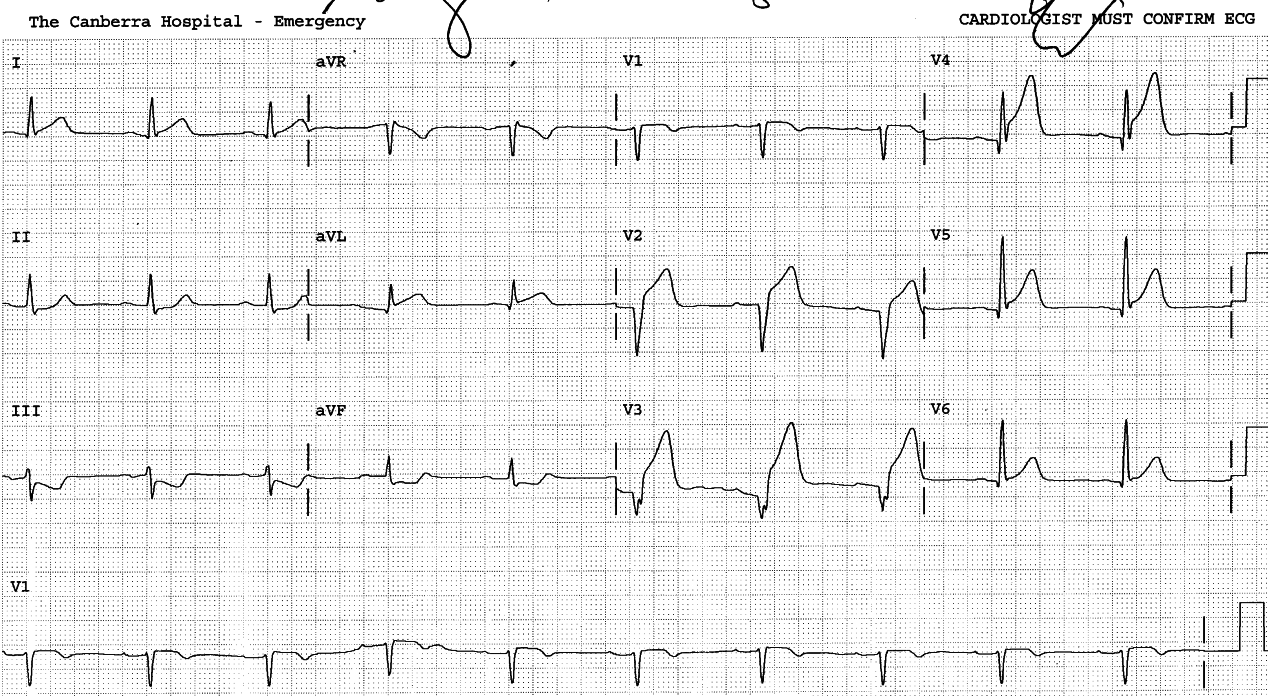 56 year old man with chest pain.