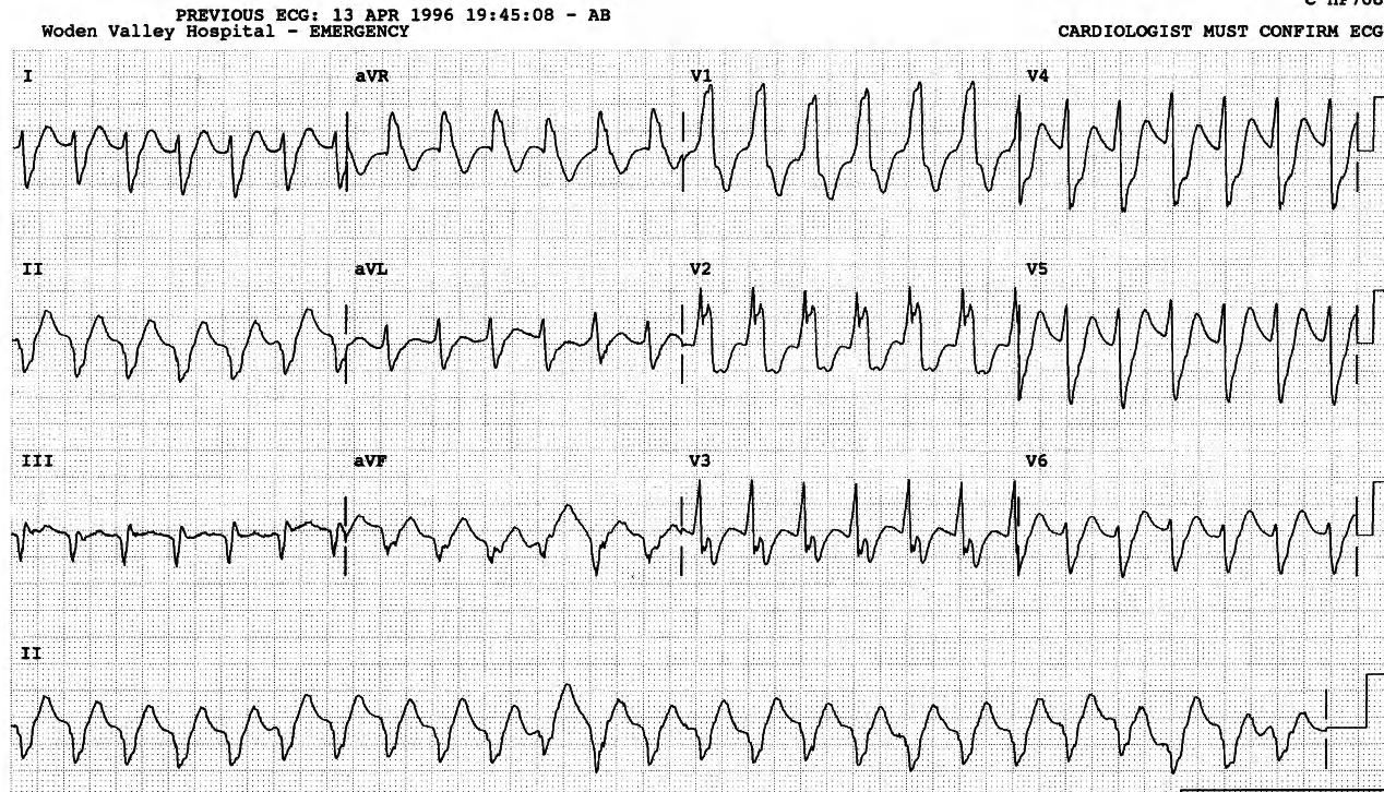 71 year old man with known old inferior infarction and chronic atrial fibrillation. 