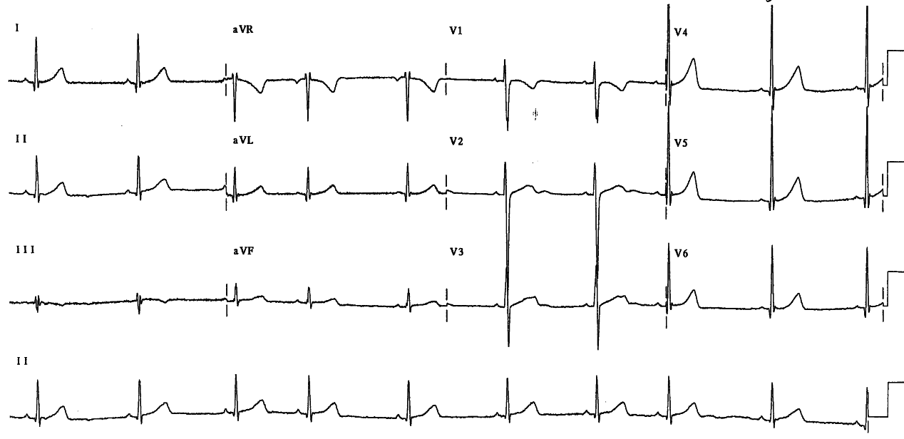 Sinus bradycardia may reflect atrial injury seen in Fig 48.