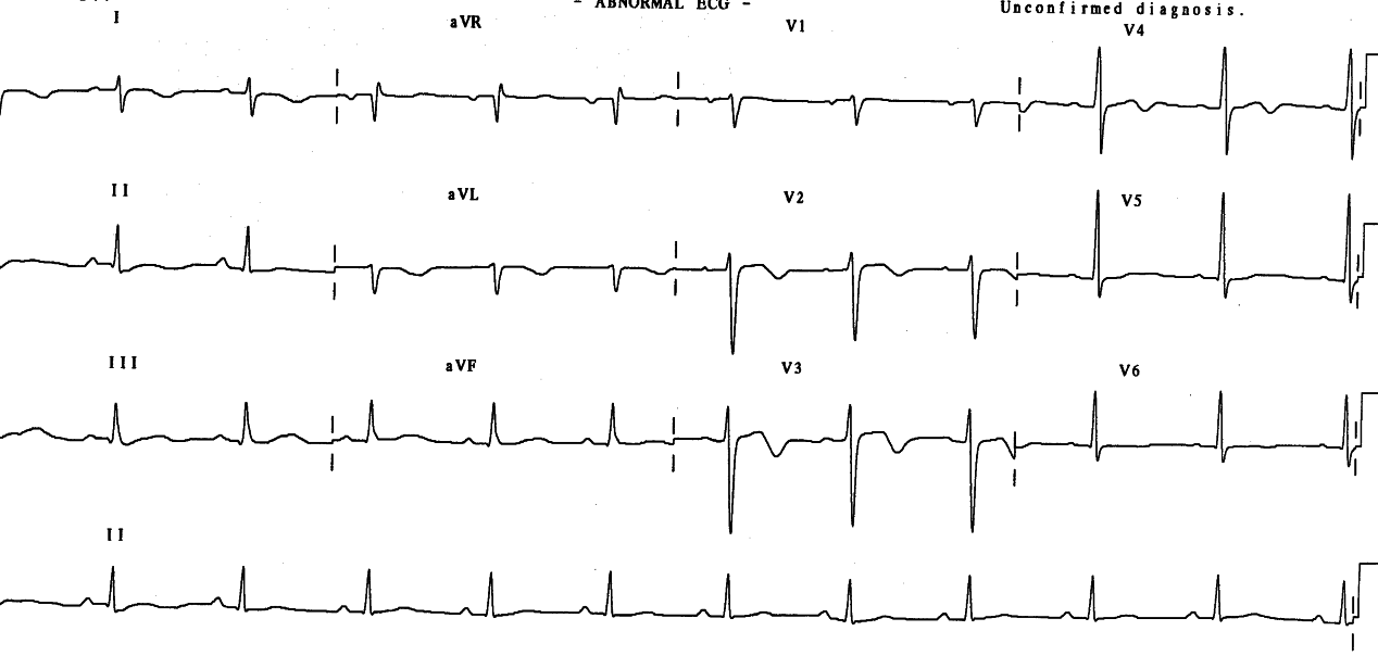 Stable pattern four days post-admission.